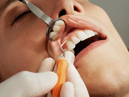 Affordable Dental Implants for Free